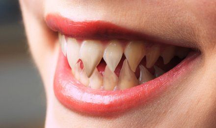 لماذا أسنان الإنسان مشابهة لأسنان القرش؟