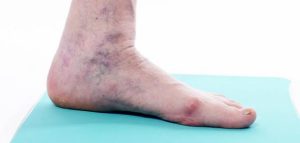 علاج الدوالي.. 5 طرق سهلة